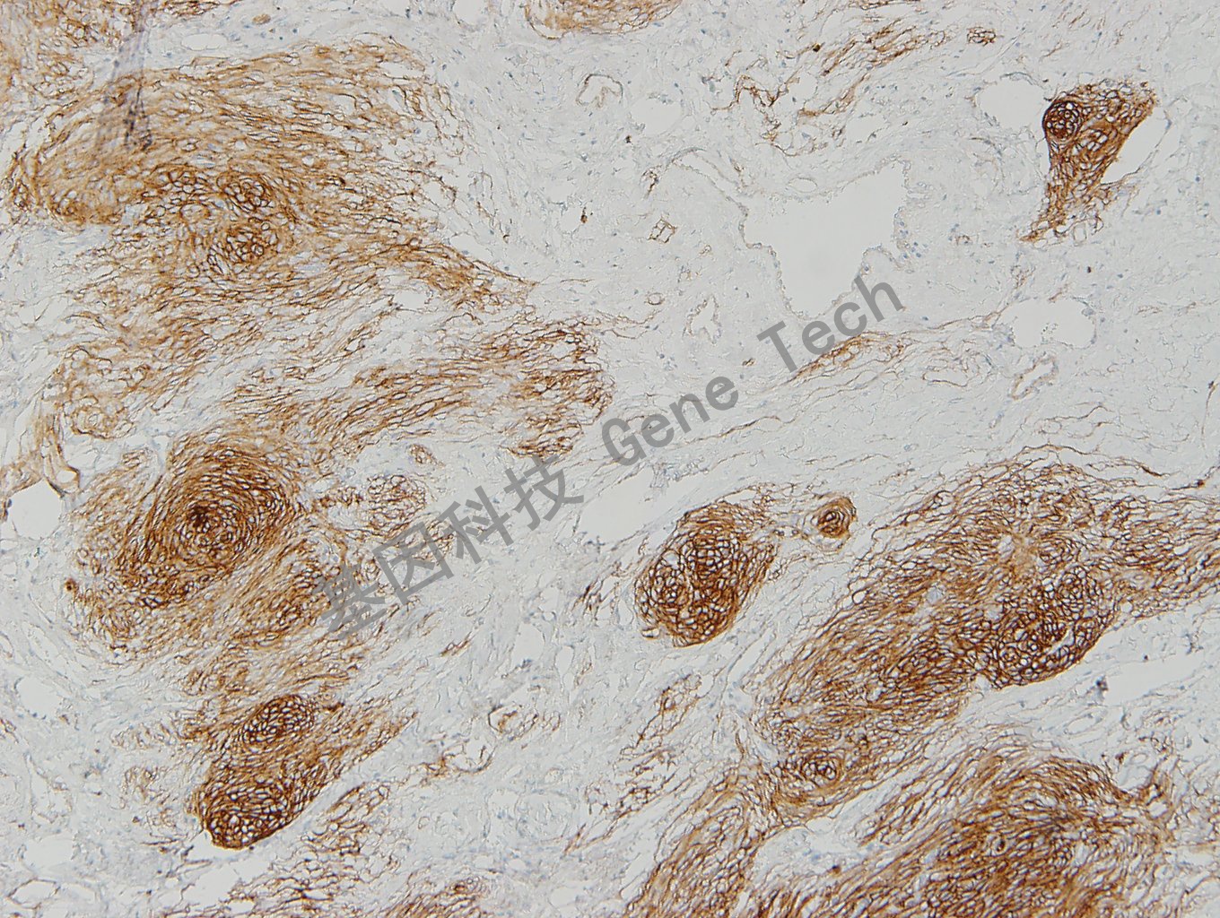 腦膜瘤.jpg 腦膜瘤.jpg